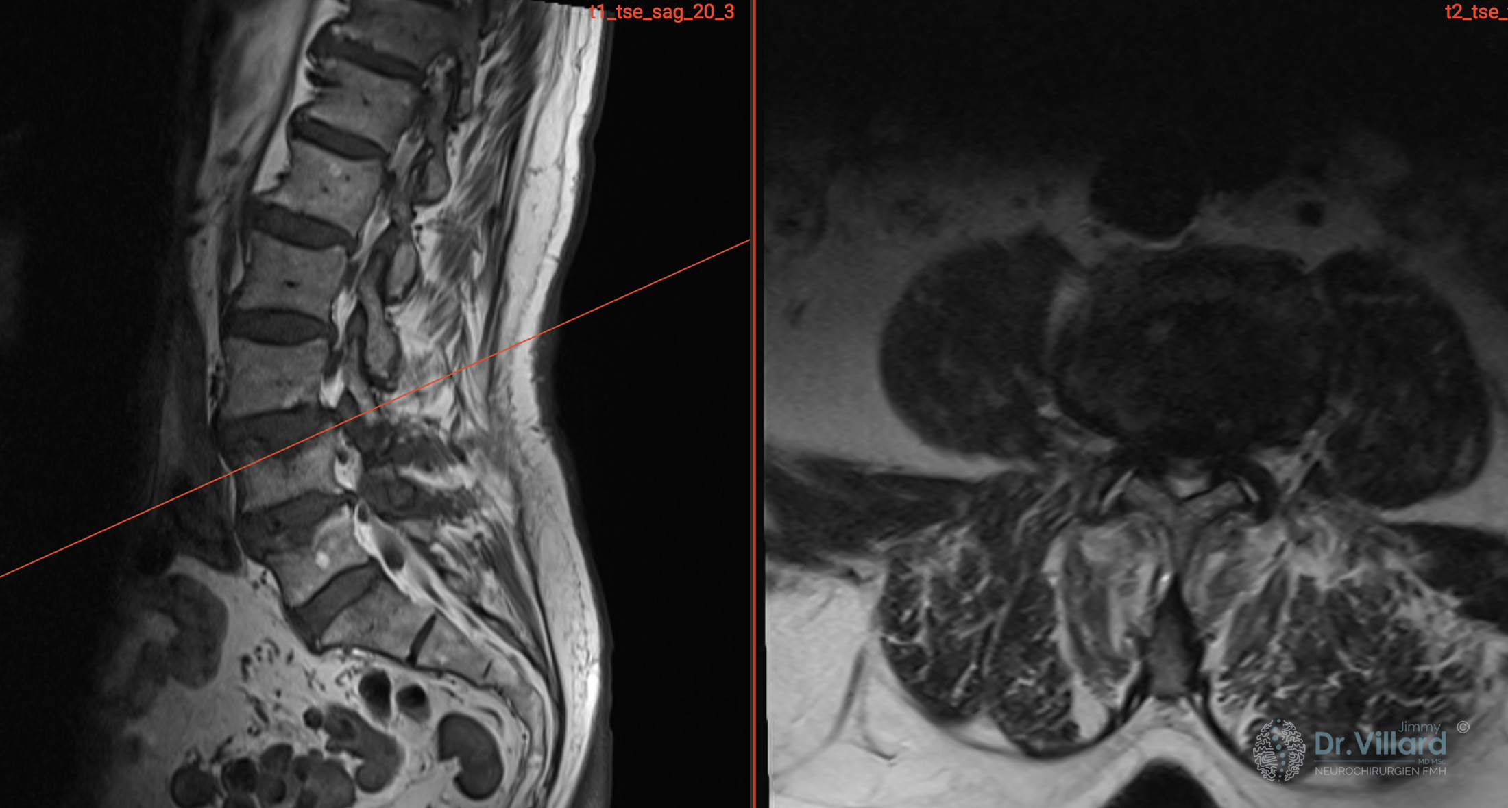 IRM d'une fracture ostéoporotique